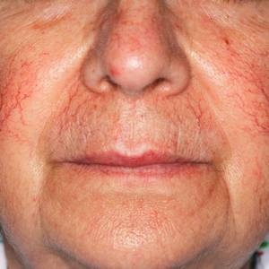 Tratamiento Telangiectasia · Luz Pulsada Intensa