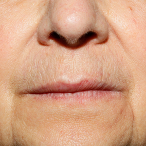 Tratamiento Telangiectasia · Luz Pulsada Intensa