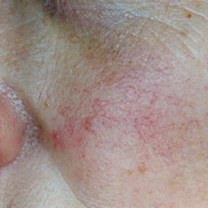 Tratamiento Telangiectasia · Luz Pulsada Intensa