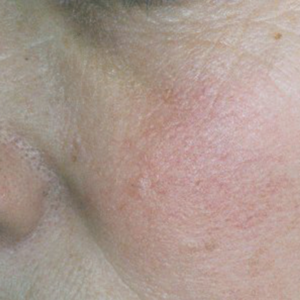 Tratamiento Telangiectasia · Luz Pulsada Intensa